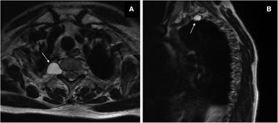 Case report: Epidural blood patches are effective in treating intracranial hypotension due to a subarachnoid-pleural fistula